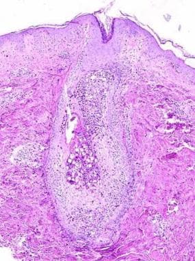 Bacterial Folliculitis Hiv