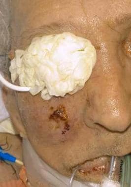 Clinical view of the face of a patient with rhinoc