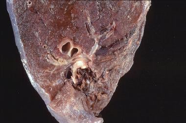 Goodpasture syndrome. Close-up view of gross patho