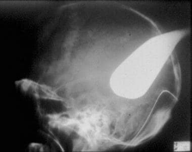 Lateral skull x-ray film of a patient who presente