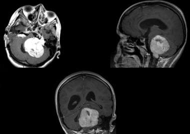 Vestibular schwannoma. T1-weighted MRI scan that d