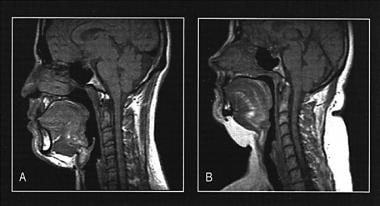 MRI rendering of a patient without obstructive sle