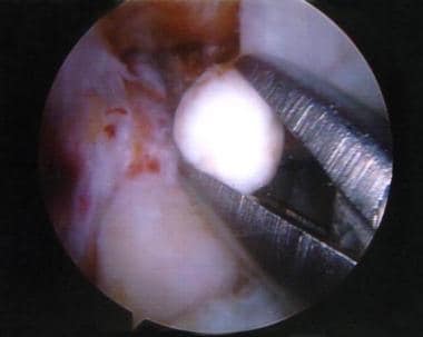 Arthroscopic view of the removal of cartilaginous 