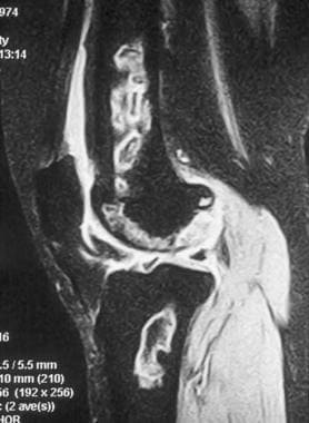 股骨远端和胫骨近端MRI。这个T