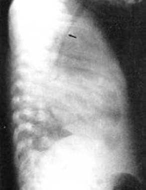 Lateral chest radiograph shows excessive tracheal 