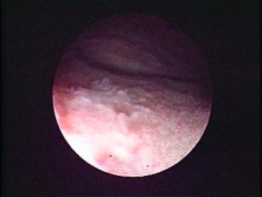 Cystoscopic appearance of trigonitis as a well-def