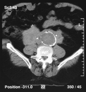 Retroperitoneal fibrosis. Noncontrast CT scan show