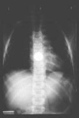 Coin lodged at the level of the aortic crossover. 