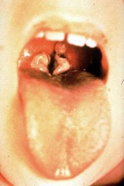 Diphtheria Clinical Presentation: History, Physical, Causes