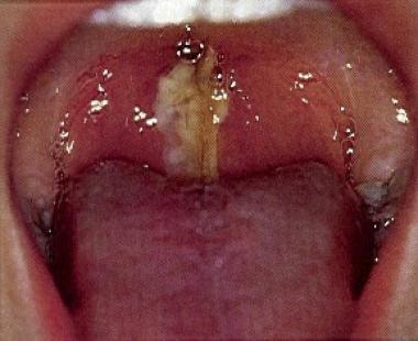 Tonsillitis caused by Epstein-Barr infection (infe