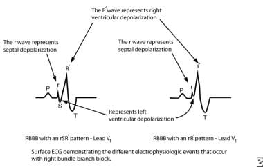 right bundle branch block