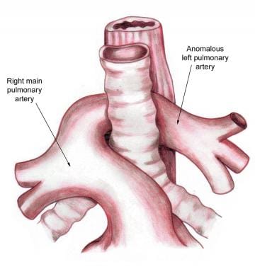 Aberrant left pulmonary artery or pulmonary artery