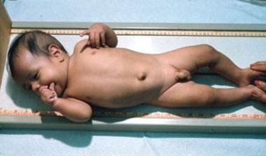 An infant shown a few months after starting thyroi