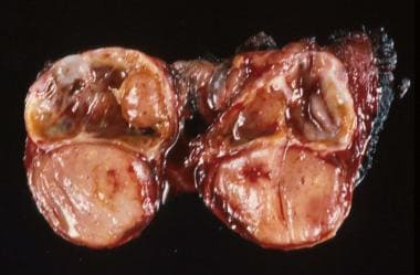 Surgical specimen of a thyroid lobe with papillary