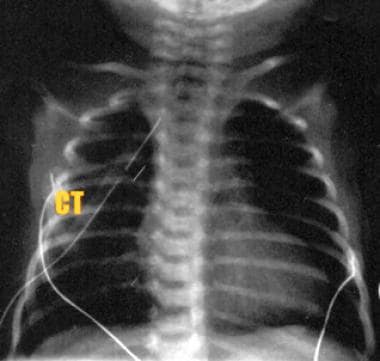 Chest radiograph following repair of esophageal at