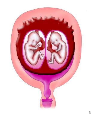 Monochorionic/diamniotic placentation. 