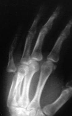 Metacarpophalangeal joint dislocation of the small