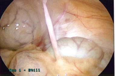 Laparoscopic view of remnant fibrous band of ompha