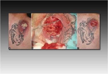 Tattoo hypersensitivity reaction. Exuberant verrucous nodules