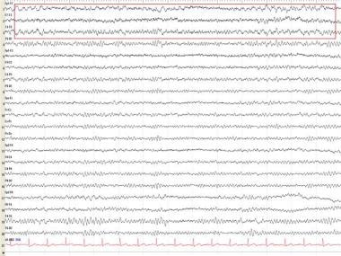 EEG in Dementia and Encephalopathy: Overview, Dementia, Vascular Dementia