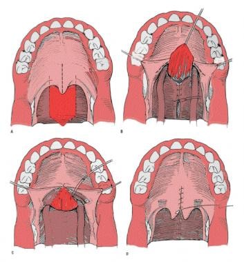 Pharyngeal flap. A mucosal flap from the posterior