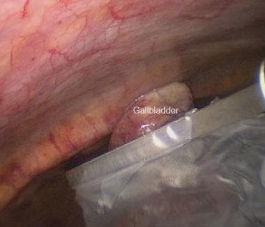 Percutaneous gallbladder drainage set and postprocedural view. (A)... |  Download Scientific Diagram