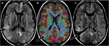 MRI scan of a patient with tuberous sclerosis comp