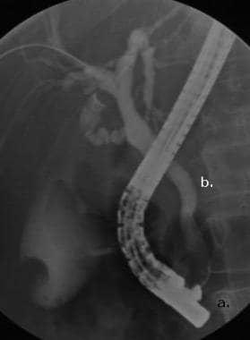 Cholangiogram. Note (a) duodenoscope positioned in