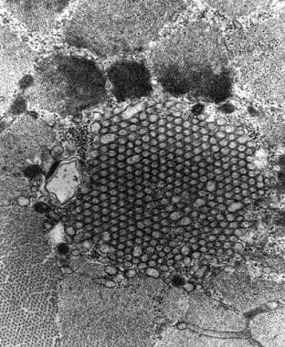 Tubular aggregate myopathy, electron micrograph. C