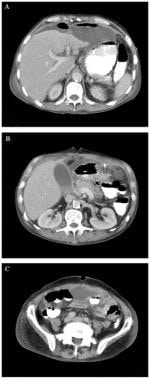 Laparostomy with Zipper in place.