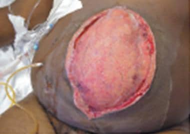 Open abdominal wound before placement of Vacuum As