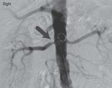 Renal angiography in a patient with refractory hyp