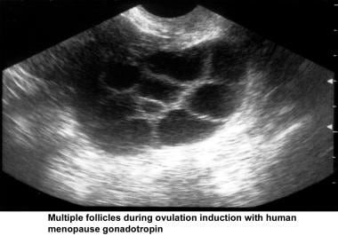 Infertility. Multiple follicles during ovulation i