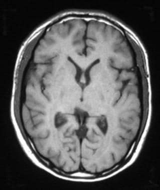 Pineal germinoma in a 19-year-old man. Axial T1-we