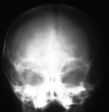 Anteroposterior (AP) skull radiograph in a child s