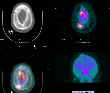 Positron emission tomography: PET images demonstra