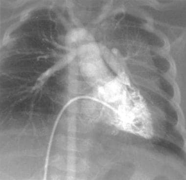 Angiogram in an infant with tetralogy of Fallot an