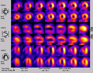 A SPECT perfusion study in a patient with a large 