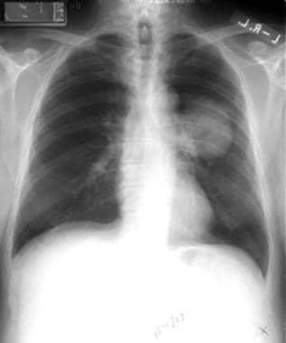 lung cancer stage 2 xray