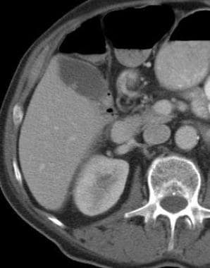 Cholelithiasis. A noncalcified filling defect is p