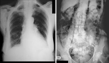 Pneumoretroperitoneum. Chest radiograph (left) and