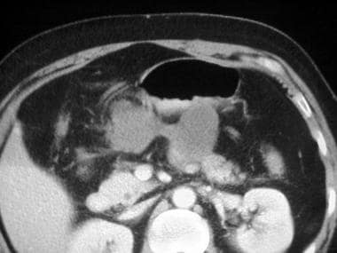 CT image of a pancreatic pseudocyst suggests the c