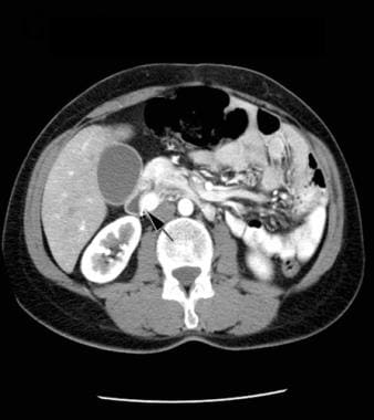 CT scan of the abdomen with contrast enhancement, 