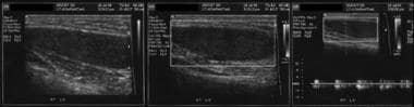 Longitudinal sonogram of the right cryptorchid tes