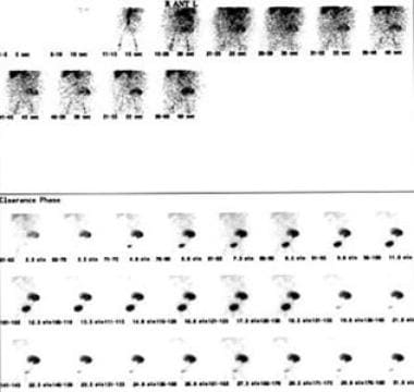 In cases of mild renal failure following renal tra