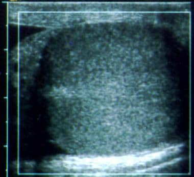 Testicular torsion. Longitudinal color Doppler ima