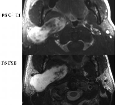 Contrast-enhanced T1- and T2-weighted MRIs in a pa
