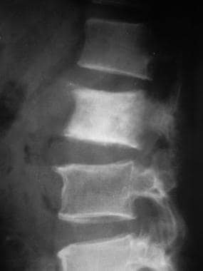 Lateral radiograph shows sclerotic metastasis of t
