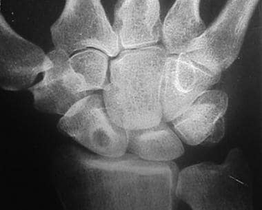 Anteroposterior radiograph of navicular cysts. The