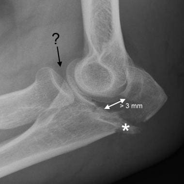Elbow, fractures and dislocations. Olecranon fract